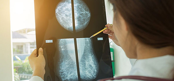 ​Un logiciel calcule pour chaque femme le risque de cancer du sein