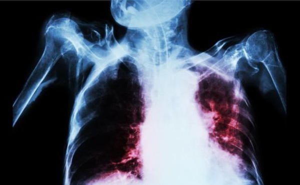 Afrique du Sud : un nouveau traitement plus rapide contre la tuberculose