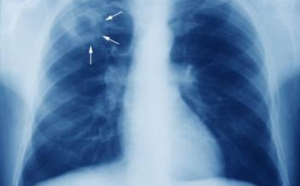 Tuberculose : 1,4 million de malades privés des soins nécessaires pendant la première année de la Covid-19 (OMS)