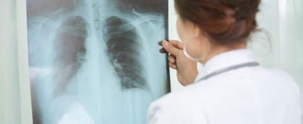 Tuberculose : La Covid-19 a provoqué une augmentation des décès pour la première fois en 10 ans