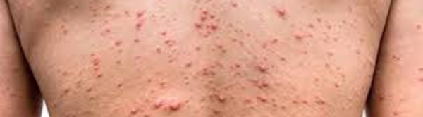 Variole du singe : un premier cas suspect détecté en France