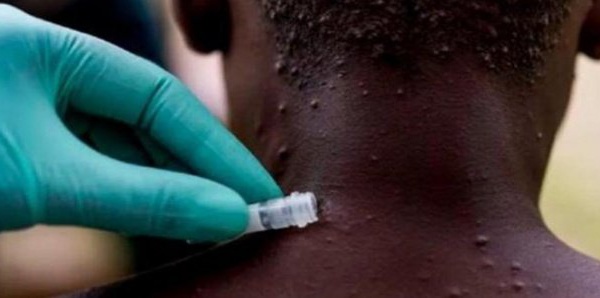 Variole du singe : 1.500 cas suspects, 600 cas confirmés et 72 décès recensés dans 39 pays