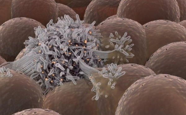 Des innovations qui améliorent les chances des patients atteints de cancer