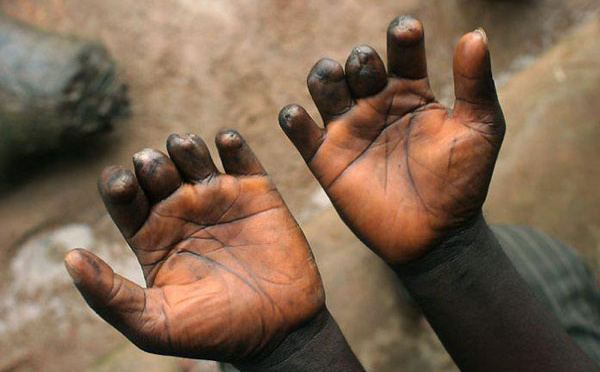  Touba : 83 nouveaux cas de lèpre recensés en 2026