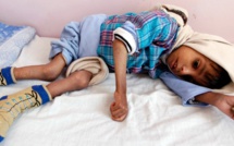 Au Yémen, les familles forcées de choisir lesquels de leurs enfants sauver de la famine