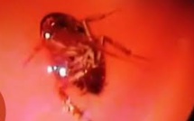 ​ Vidéo : un cafard vivant retrouvé dans le crâne d'une Indienne