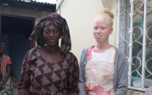 En Gambie, la sensibilisation à la cause des albinos porte ses fruits