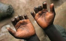 Santé à l'agonie à Diourbel : La lèpre avance gravement avec 68 cas recensés, la CMU traîne une dette de 352 millions