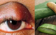 ​6 remèdes naturels pour guérir un orgelet rapidement