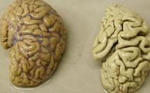 Alzheimer : la progression de la maladie défie les chercheurs