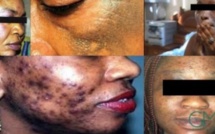 ​Publicité sur la dépigmentation ou « Xessal » : le Cnra met en demeure Tfm, Sen Tv et Zik Fm