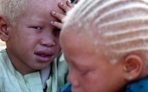 Thiès: « Y’en a marre » se veut l’avocat des albinos et aveugles