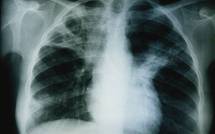 Tuberculose à Thiès : 500 nouveaux cas attendus en 2012