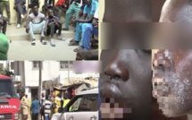 La maladie dermique détectée chez des pêcheurs atterrit à Rufisque: 180 patients dont 2 cas graves