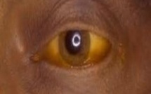 Tambacounda: 4 cas de Fièvre jaune détectés, 2 morts annoncés