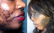 Business des crèmes éclaircissantes: les utilisateurs à la merci des « chimistes cosmétiques » exposent leurs peaux à maints dangers 