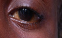 « L’épidémie de conjonctivite peut être un signe de Covid-19 » (Ophtalmologue)