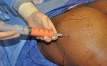 Grossissement fesses: ce que révèle l’enquête de la Su sur "Docteur" Diop