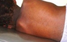Tambacounda : 7 cas de rougeoles enregistrés