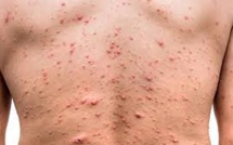 Variole du singe : un premier cas suspect détecté en France