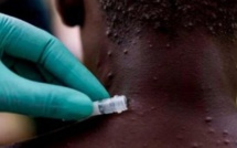 Variole du singe : 1.500 cas suspects, 600 cas confirmés et 72 décès recensés dans 39 pays