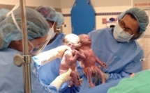 Grossesse : les jumeaux 'mono-mono', une naissance exceptionnelle