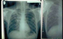 « Le Sénégal a enregistré 420 décès dus à la tuberculose en 2022 » (coordinatrice Pnt)