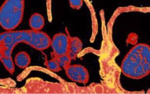 Epidémie de rougeole en Guinée