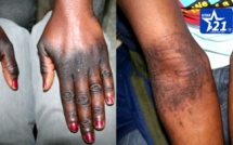 Sénégal : 67 sur 100 femmes se dépigmentent, un combat pour la santé publique