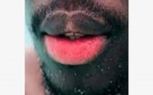 Dépigmentation des parties intimes aux baumes "lèvres roses": un phénomène inquiétant au Sénégal