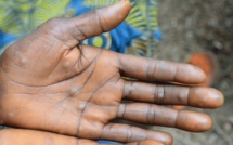 Mpox : au Sénégal, tous les cas suspects se révèlent négatifs (Dr Boly Diop)