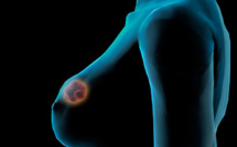 ​Fort taux de mortalité: 500 femmes tuées par le cancer chaque année