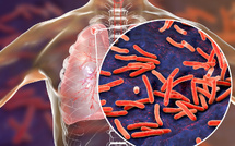 Lutte contre la tuberculose : le Sénégal veut renforcer la mobilisation des ressources locales