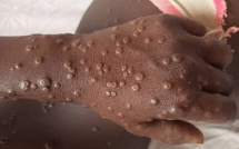 Sénégal : 125 cas suspects de mpox signalés dans plusieurs localités