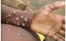  Santé : un deuxième cas de Mpox confirmé à Dakar, 20 contacts identifiés