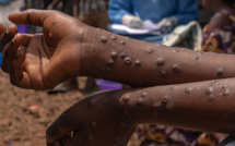 Mpox : deux nouveaux cas confirmés au Sénégal, 42 contacts suivis