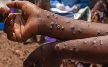 Mpox et Fièvre de la Vallée du Rift : 56 cas dont 8 décès, Richard-Toll, Saint-Louis, Podor, Pété, Louga, Matam et Dakar touchés (Ministère) 