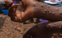 Sénégal : un nouveau cas de Mpox enregistré (Ministère)