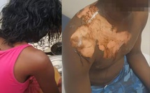 Drame conjugal à Boune : elle verse de la bouillie chaude sur son mari après une dispute