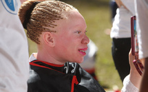 À Madagascar, une série d’attaques contre des personnes albinos ravive la peur