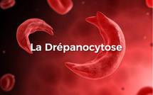 Drépanocytose à Kolda : plus de 250 enfants suivis et un traitement à vie inaccessible pour les familles
